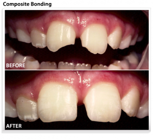composite bonding