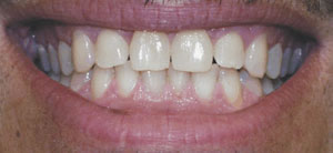 before teeth whitening