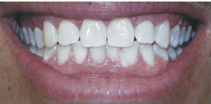 after teeth whitening